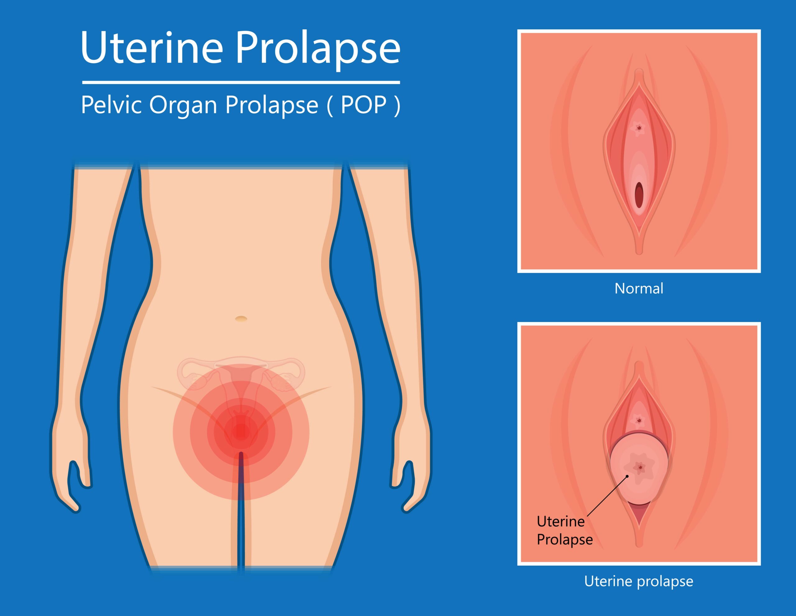 PROLAPSO UTERINO-min